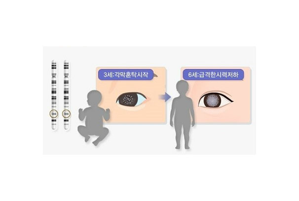 백내장 눈 비교2